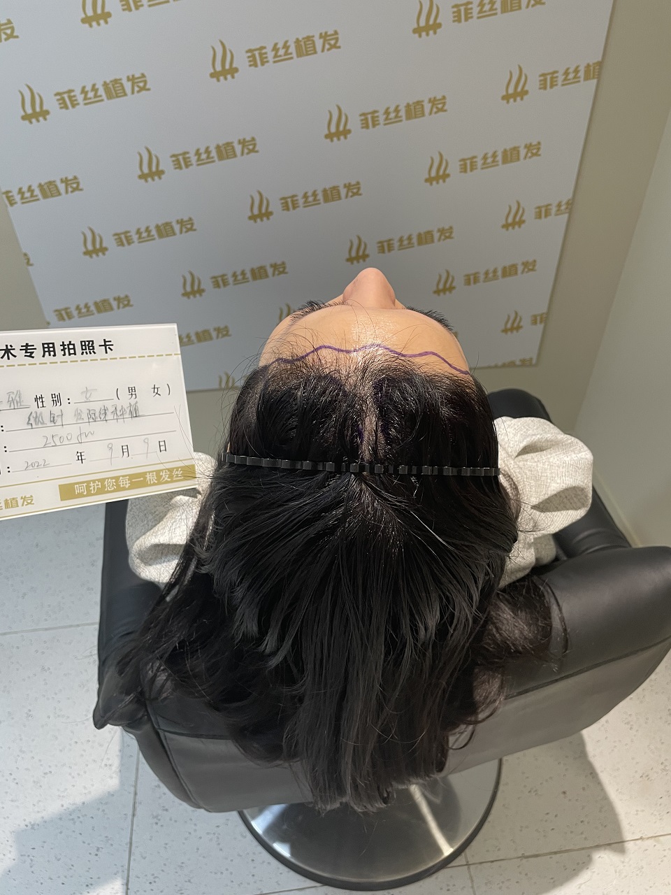 植发能保持多久