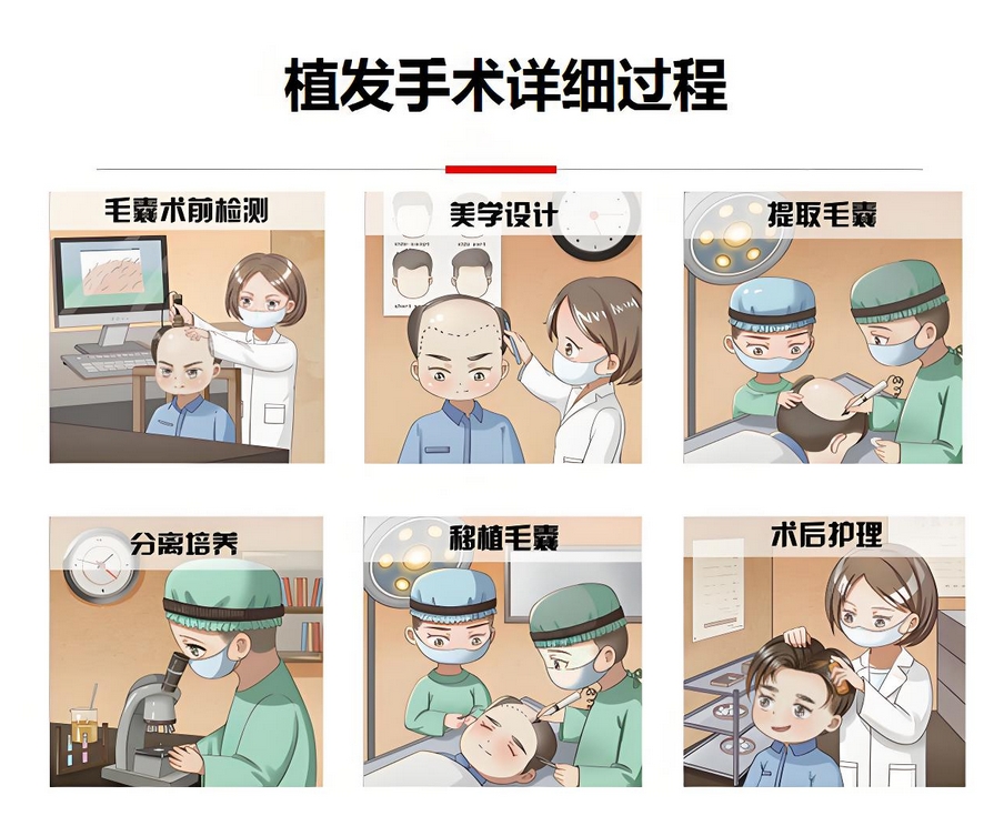 植发手术
