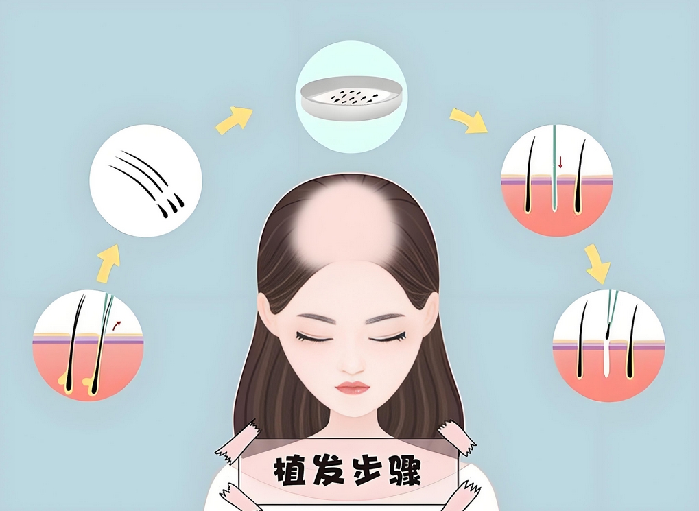 女性植发