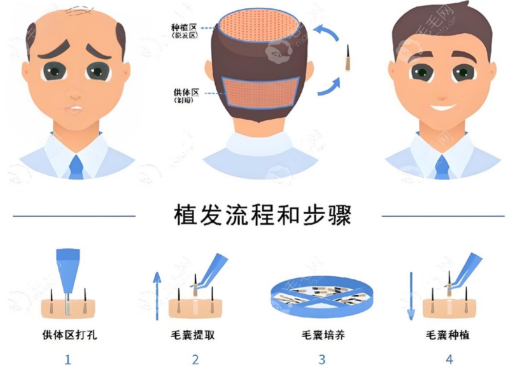 植发与假发