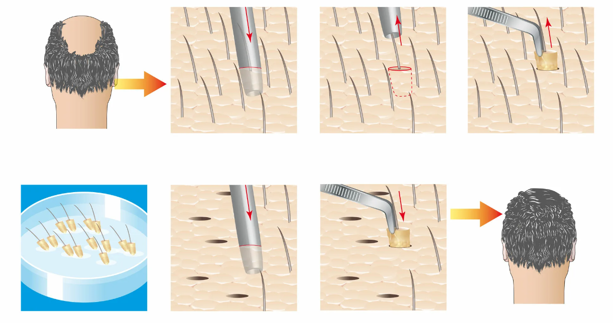 南京植发术后饮食建议